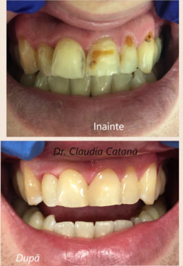 Tratamente 50 doctor claudia catana inainte dupa tratament 16
